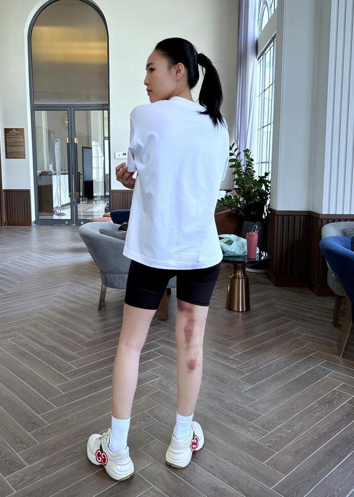 SHOCK: Ninh Dương Lan Ngọc lộ vết bầm tím lớn ở chân